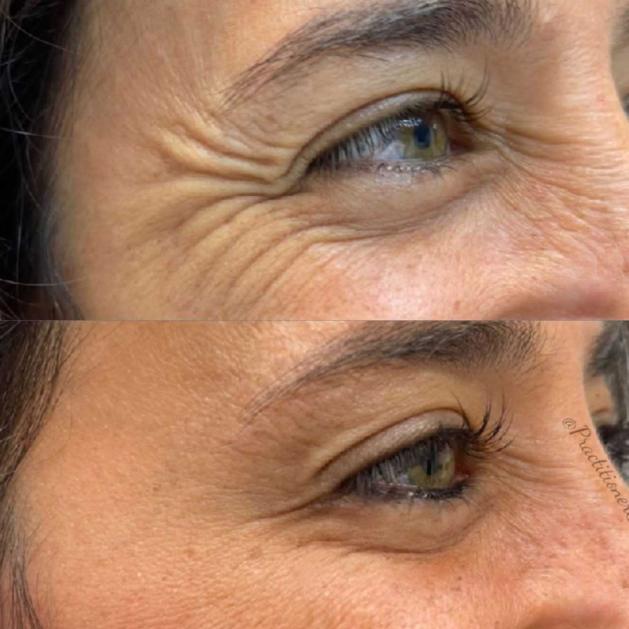 Crows Feet Botox in Novi