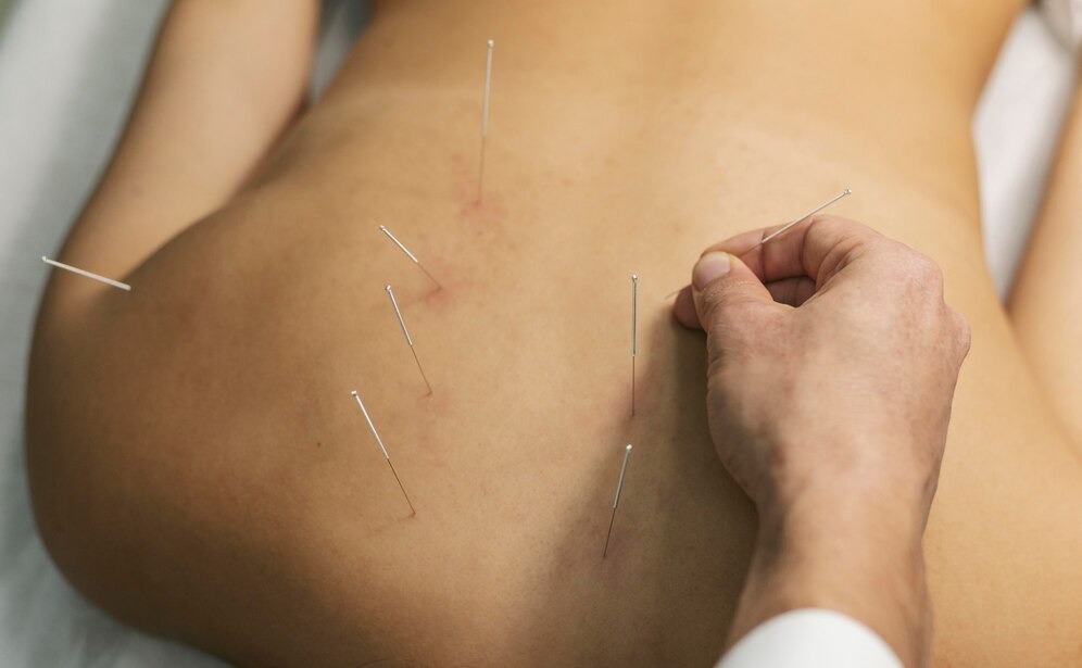 dry needling in Adelaide