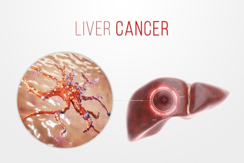 liver cancer